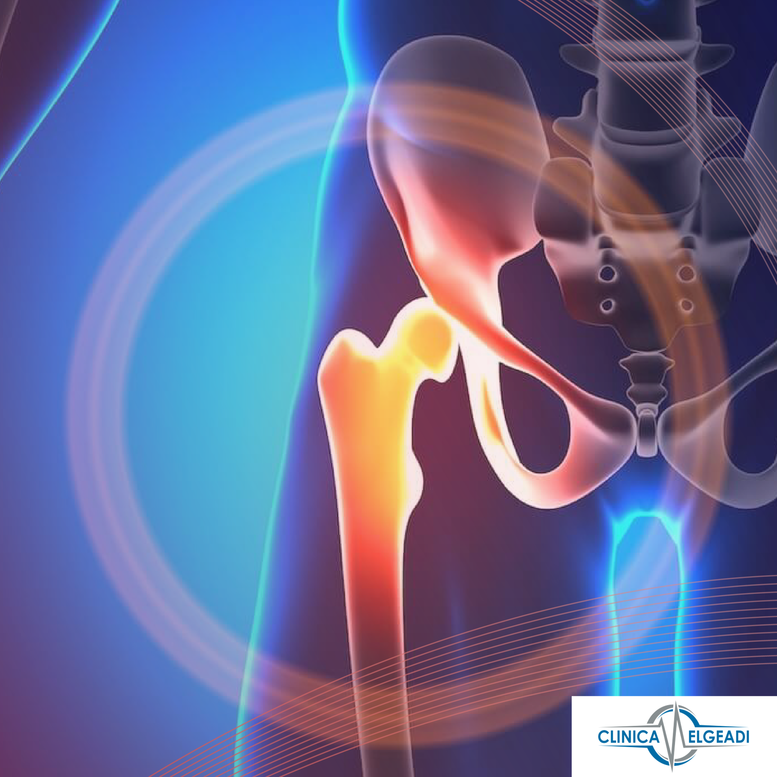 ¿QUÉ ES UNA PUBALGIA O HERNIA DEL DEPORTISTA? por CLÍNICA ELGEADI