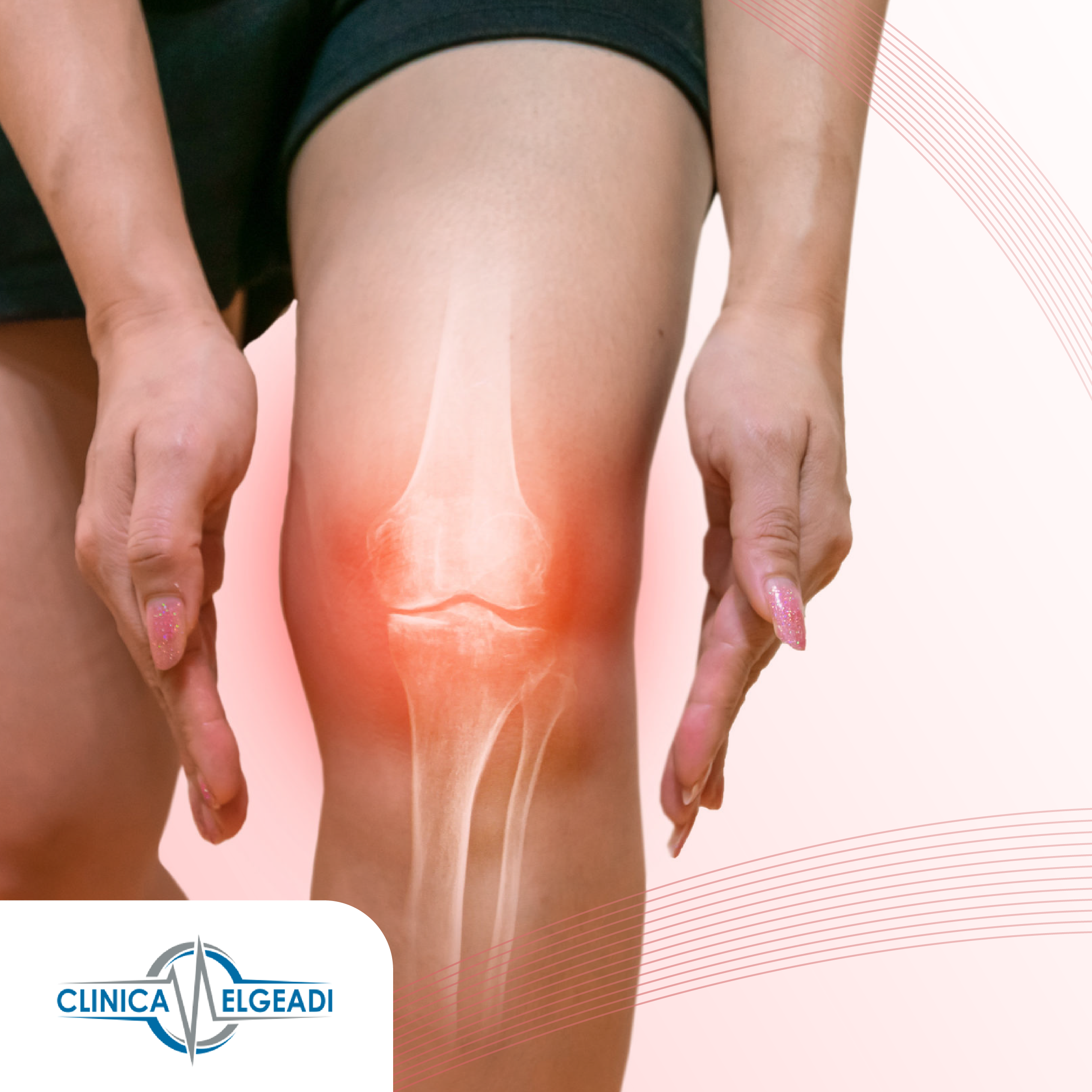 DIAGNÍSTICO Y TRATAMIENTO DE LA LESIÓN DE CARTÍLAGO ARTICULAR, por CLÍNICA ELEGEADI