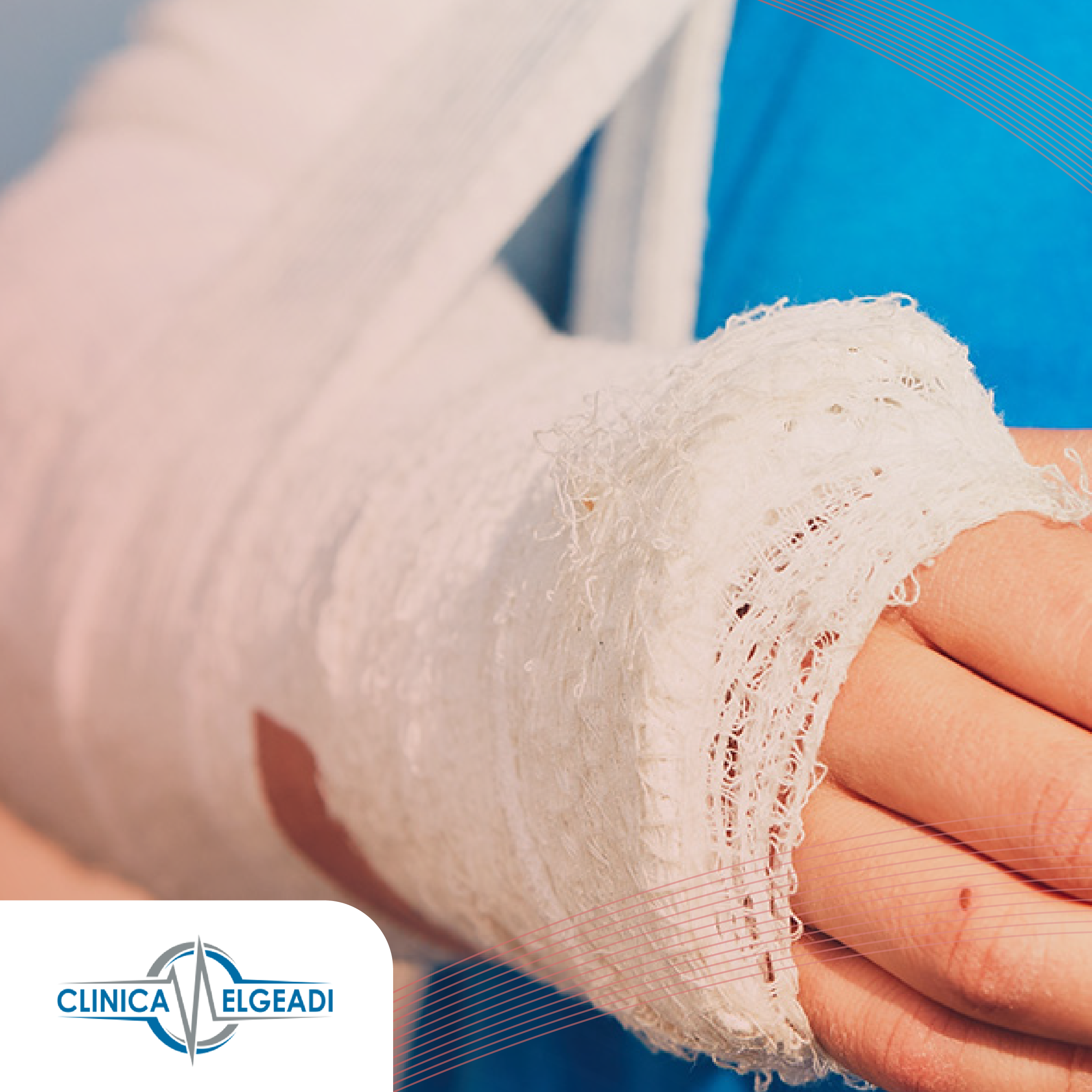 FRACTURA EN RADIO Y CÚBITO, por CLÍNICA ELGEADI
